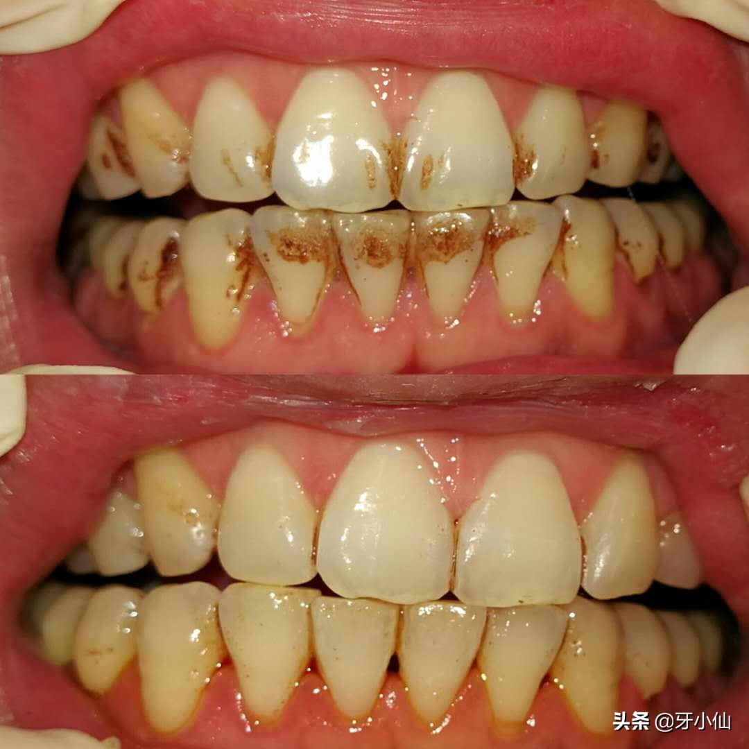 牙龈出血口臭跟牙齿不贴合,有个牙齿晃动牙龈出血口臭