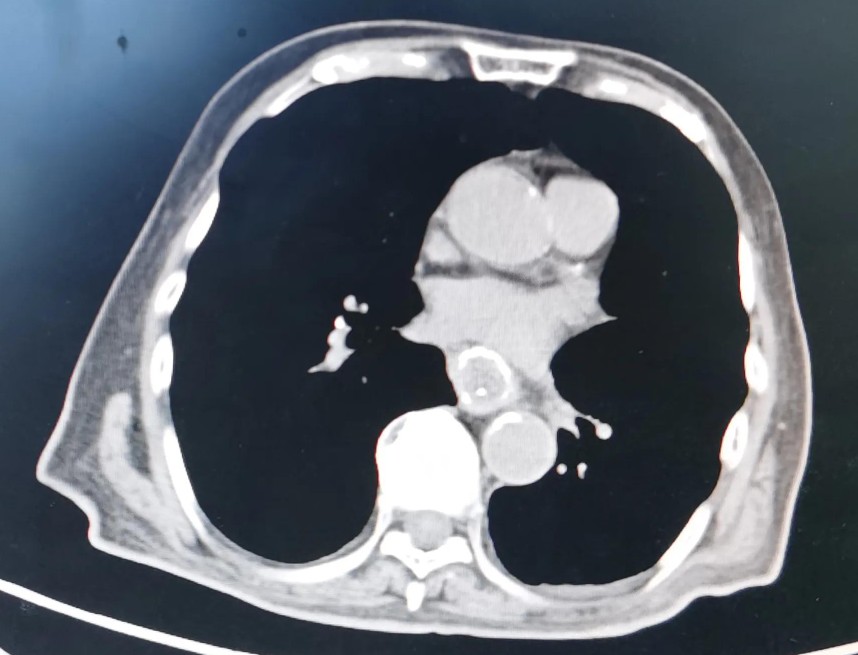 贲门癌吐血抢救,中国最著名的贲门癌治疗专家