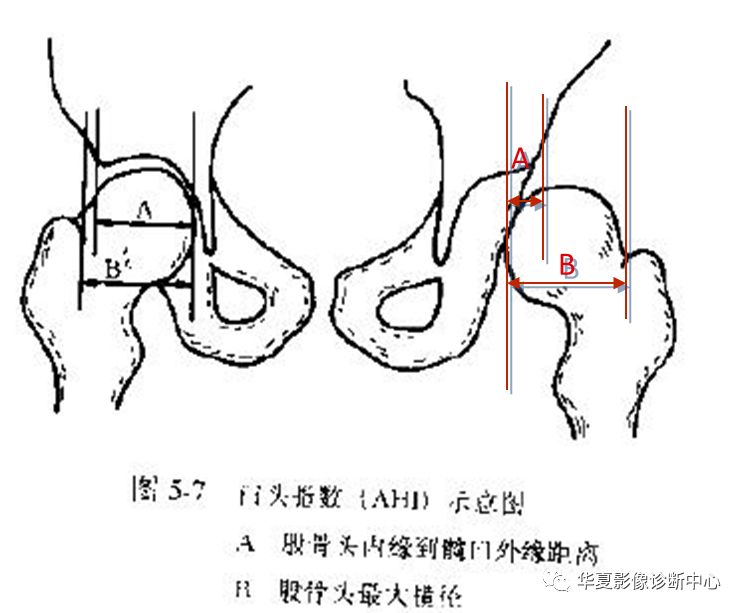 先天性髋关节脱位截骨术全过程,先天性髋关节脱位可以考驾驶证吗