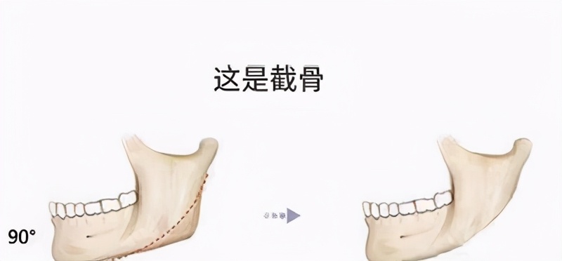 下颌角宽大怎么改善男生,怎样改善下颌变小