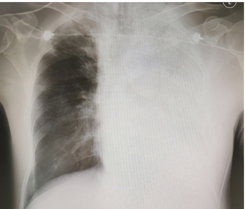 脓毒症的死亡率有多高,脓毒症致死率