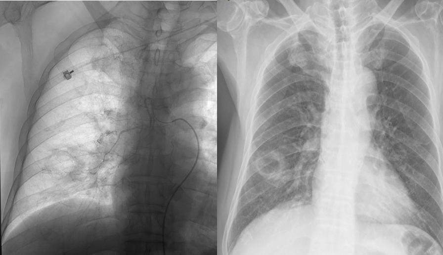 肺鳞癌介入治疗成功率,肺鳞癌最好的免疫化疗方案