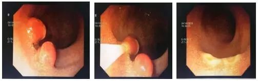 6岁宝宝息肉,6岁孩子直肠息肉