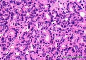 外阴良性肿瘤需要动手术吗,外阴良性肿瘤切除术