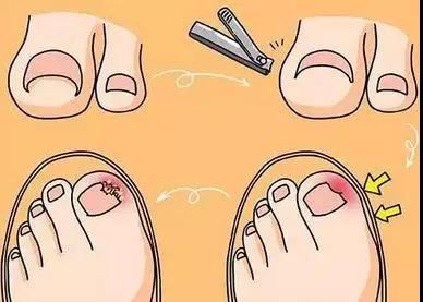 甲沟炎拔过指甲后怎么预防,脚趾盖掉了如何预防甲沟炎