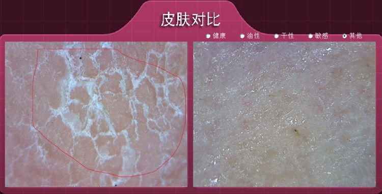 为啥要去脸部角质,为什么要去皮肤上的角质