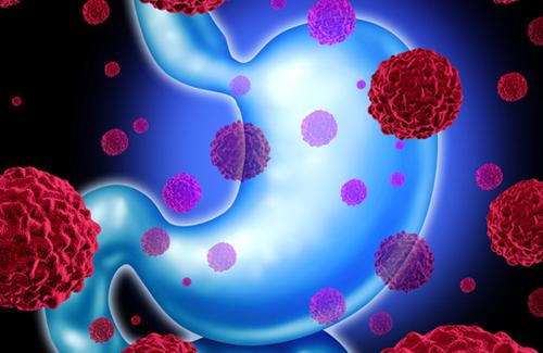 胃癌盆腔转移能治愈吗,怀疑盆腔炎复发要做什么检查