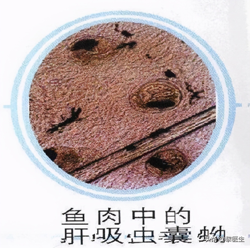 得了肝吸虫病有什么症状吗,肝吸虫感染有什么征兆