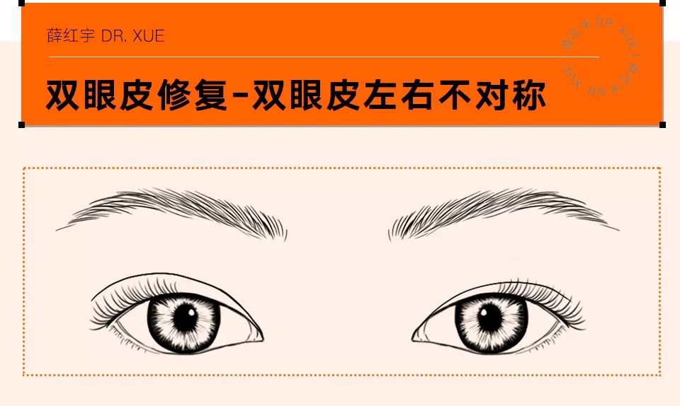 双眼皮整形修复,潘贰双眼皮修复