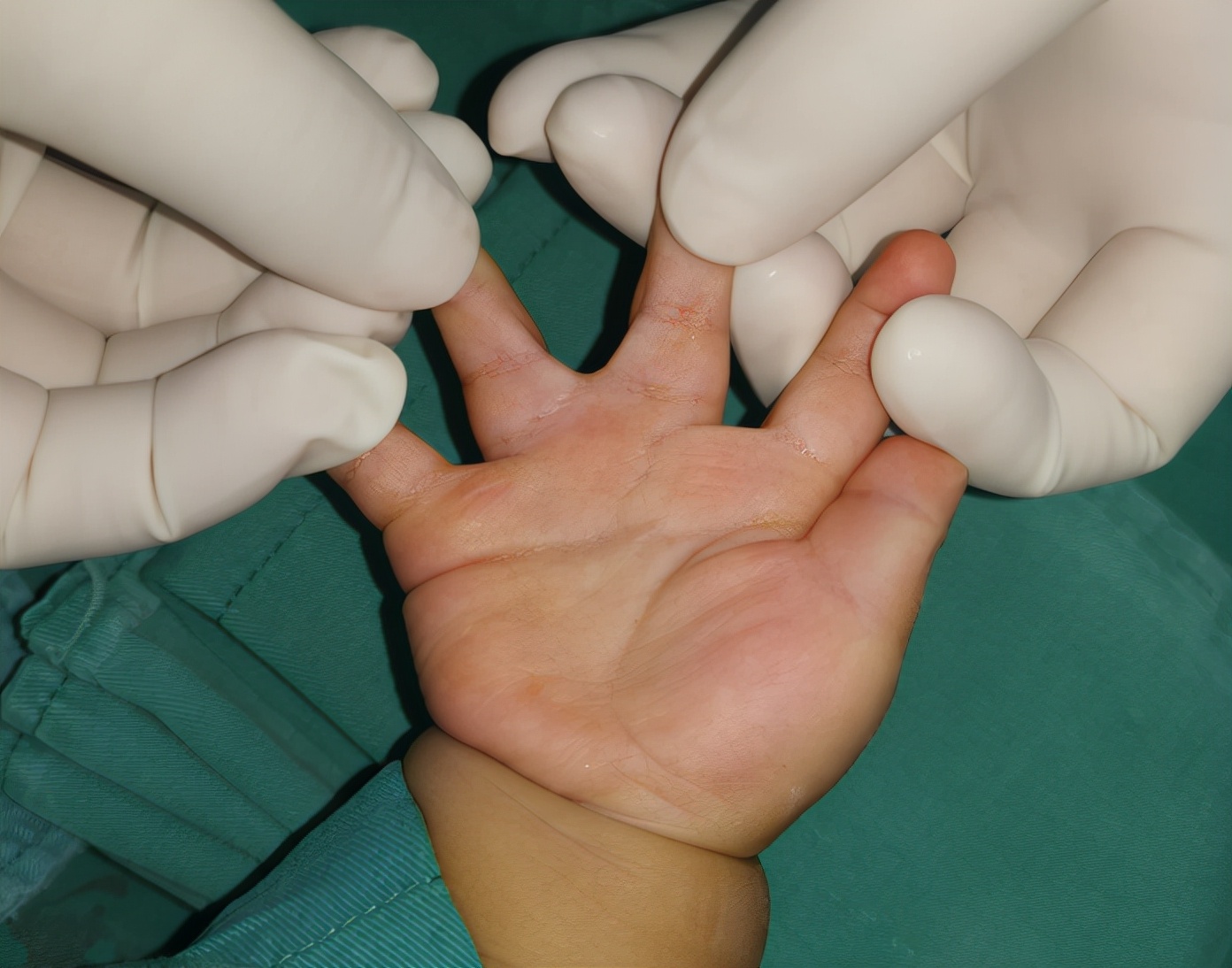 并指畸形免植皮案例,并指畸形