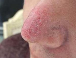 酒糟鼻如何应对,酒糟鼻是常见的美容病该如何应对