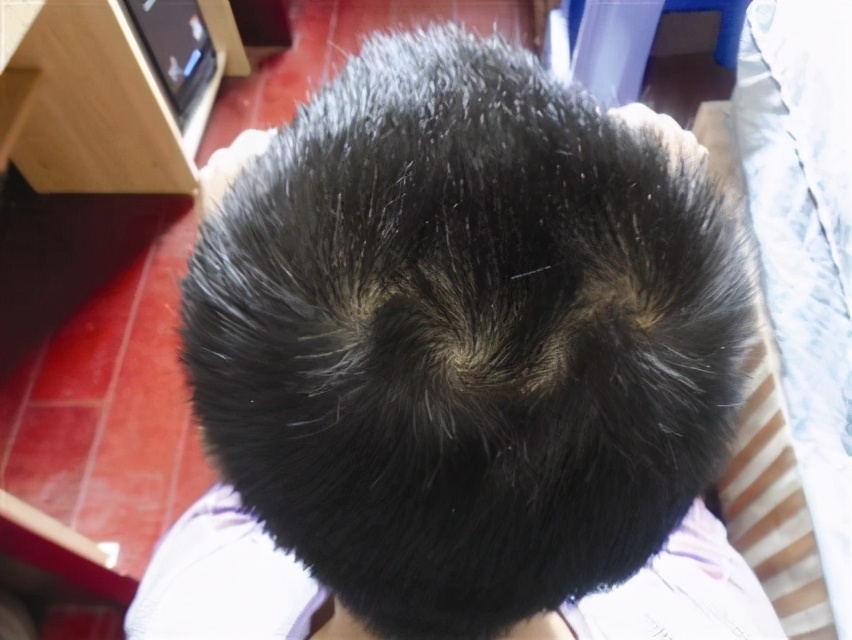 孩子的头旋长偏了是怎么回事,孩子的头旋是歪的