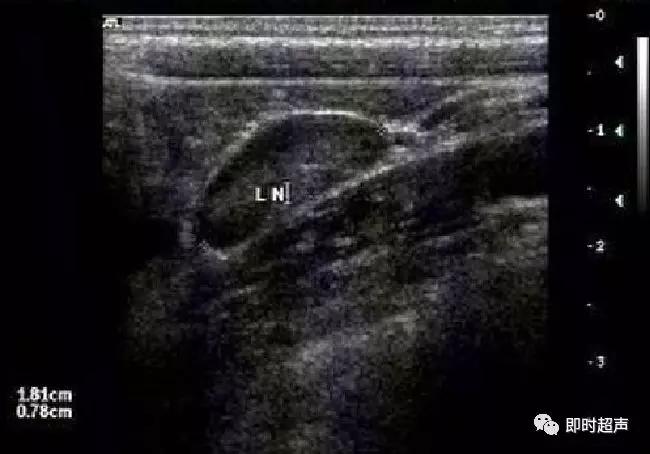小儿消化道急症超声