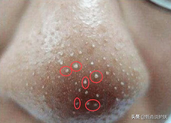 鼻子挤出白色条状物中医,鼻子边挤出白色条状物留下一个洞