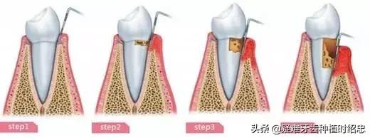 如何预防和治疗牙周炎,矫正完怎么预防牙周炎