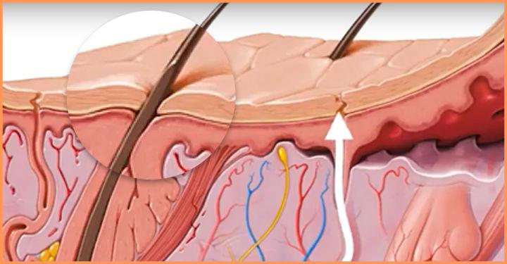 毛孔粗大到底怎么办才好,毛孔粗大治不好了吧