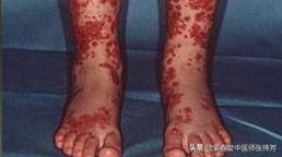 过敏性紫癜能自愈需要干预吗,过敏性紫癜怎样才能算是痊愈呢