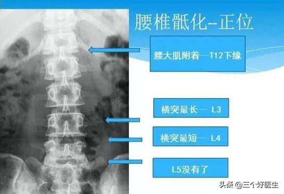 腰椎退行病变腰痛不止怎么办,久治不愈腰屁股腿疼