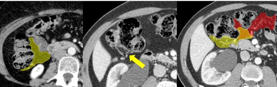 这样的解剖结构容易忘？重新认识肠系膜