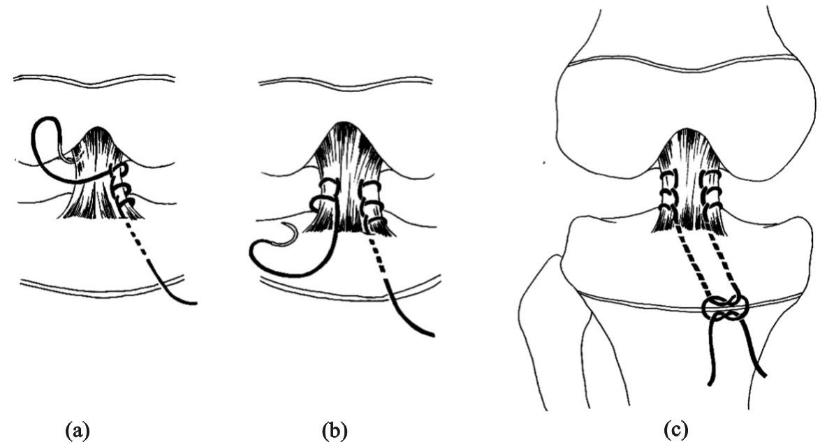 膝关节前叉韧带损伤最佳恢复方法,膝关节前韧带断了必须手术吗