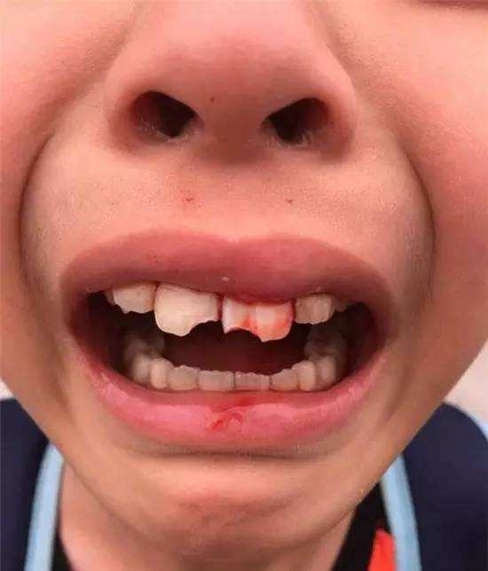 小孩牙摔断了怎么办,孩子牙摔断了有什么预兆