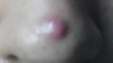 脸上老是长痘怎样内调,脸上老是长痘怎么办小妙招