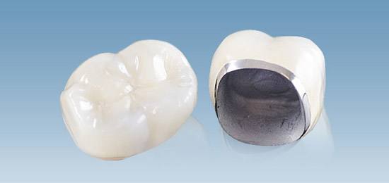 为什么有的烤瓷牙特别贵,烤瓷牙从几百到几千有什么区别