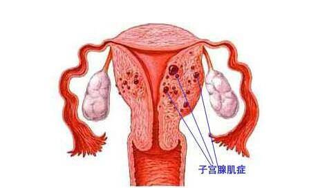 妇科疾病的介入治疗，这四种妇科疾病不用切除子宫也可以治好