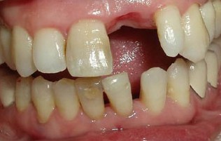 爱美者的100个困惑,牙齿缺失不想种植怎么办