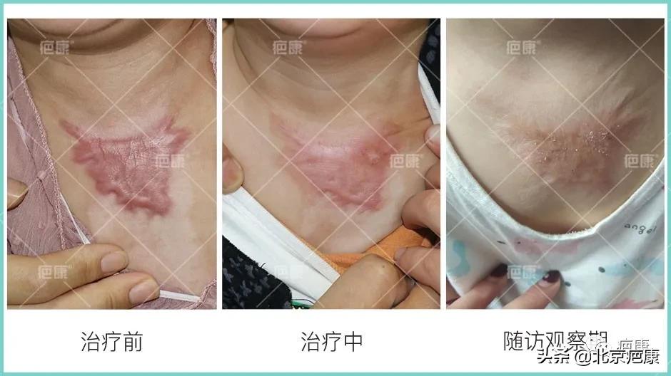 孩子烧伤疤痕，单纯预防多长时间能看到效果？
