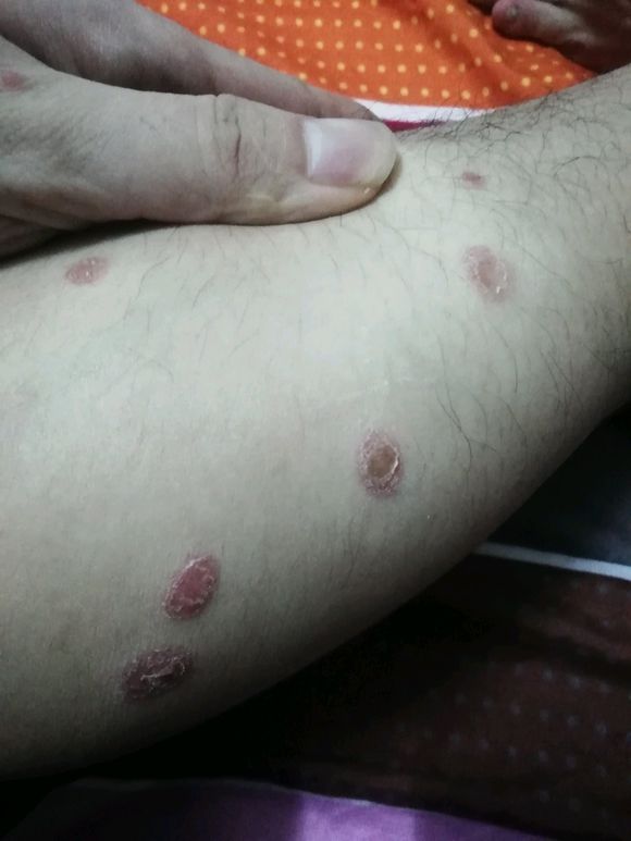 猫咪得了猫癣怎么才能治好它,小猫咪得了猫癣用碘伏可以治愈吗