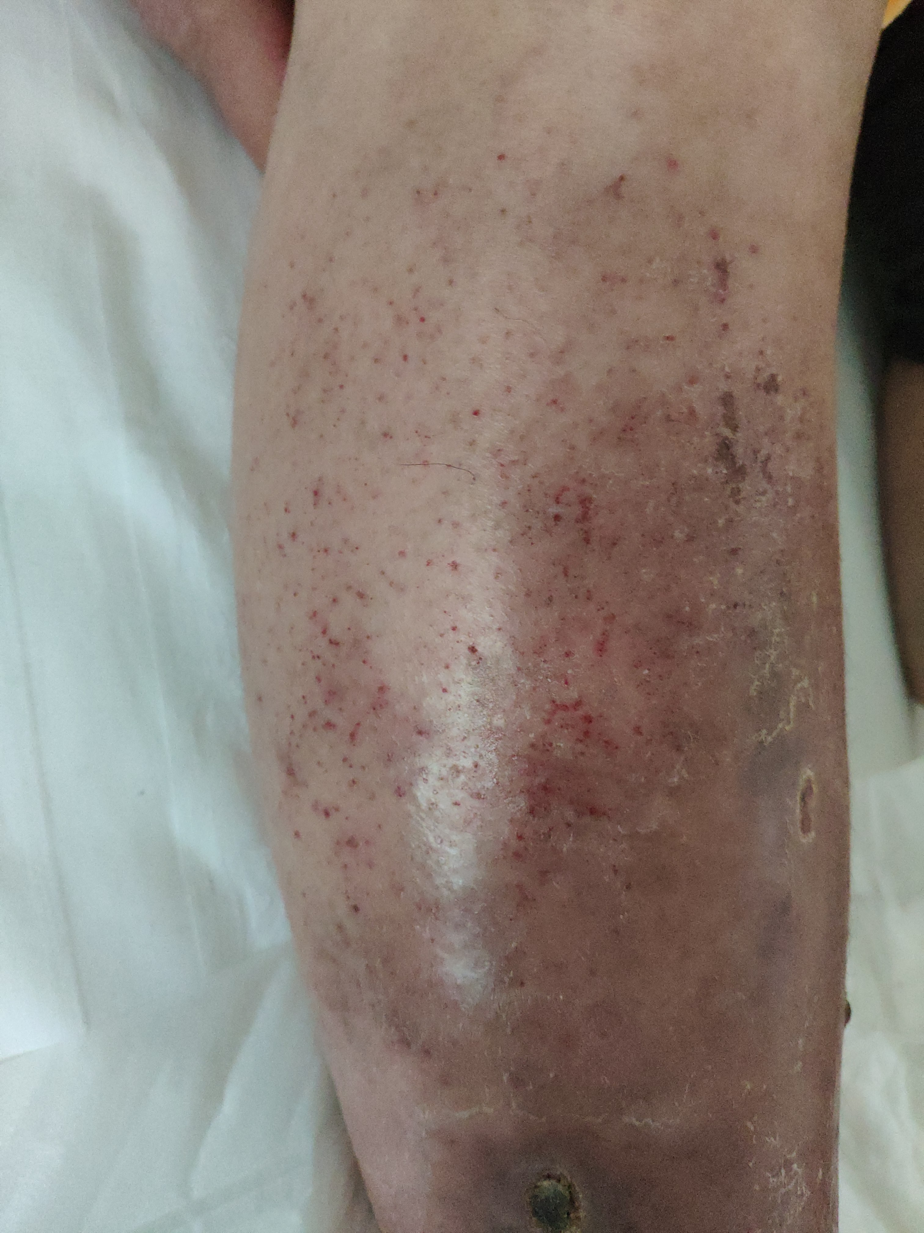 小腿皮肤瘙痒溃烂不愈什么原因,下肢皮肤出现溃烂用什么药