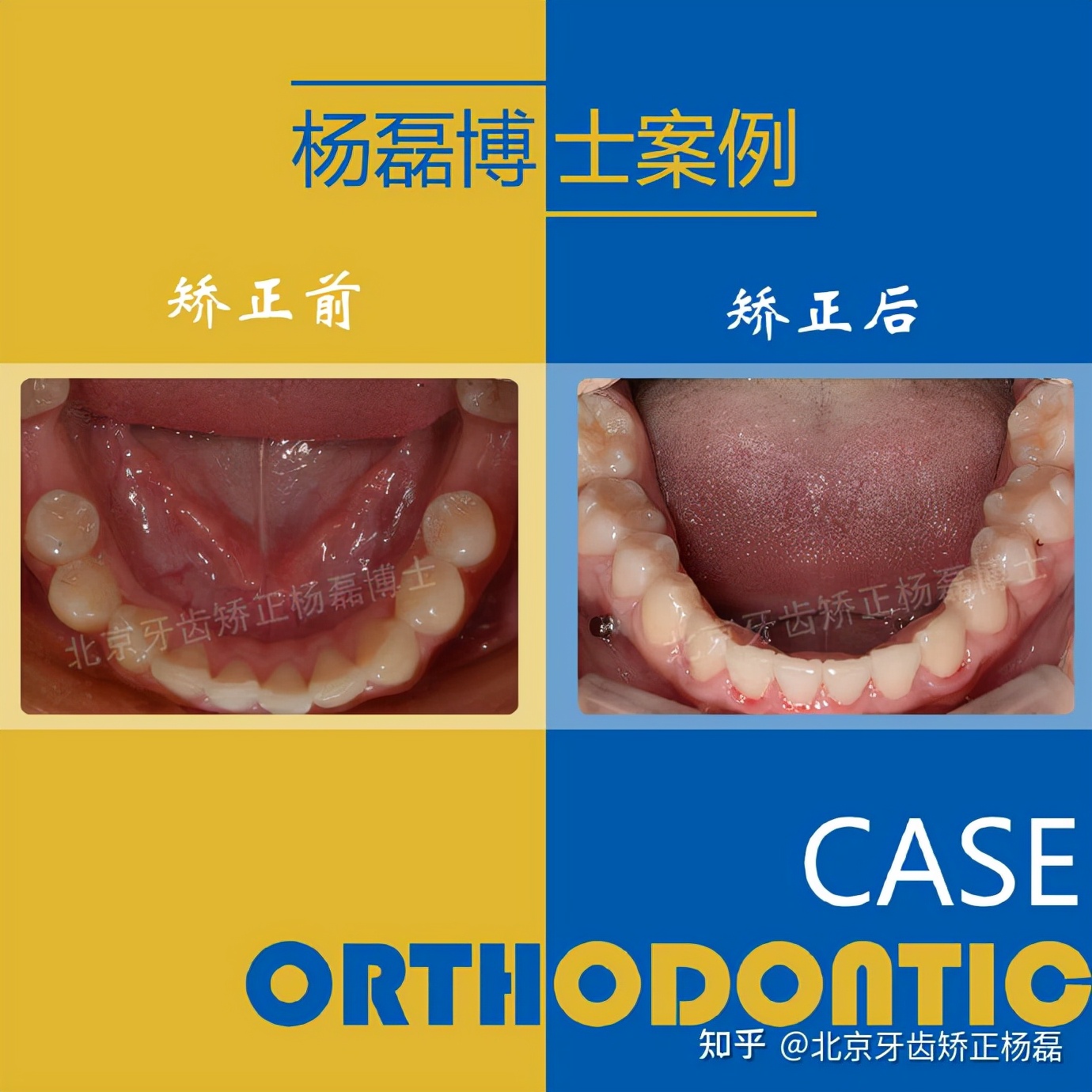 整牙半隐形牙套,缺牙可以用隐形牙套矫正的全过程
