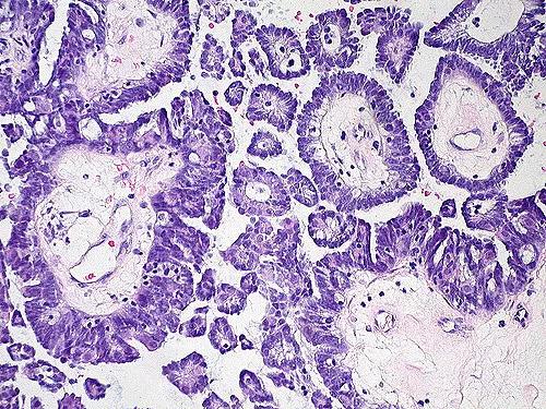 卵巢有肿物用切除吗,卵巢囊实性肿物恶性概率多大