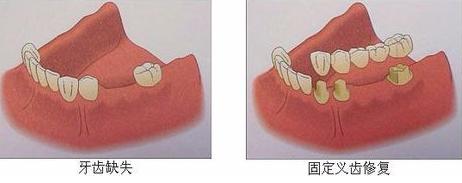 种植牙选什么牙体和牙冠,种植牙有几种选择