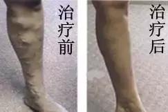 腿上有蚯蚓纹怎么回事,腿上出现蚯蚓似的纹路是怎么回事