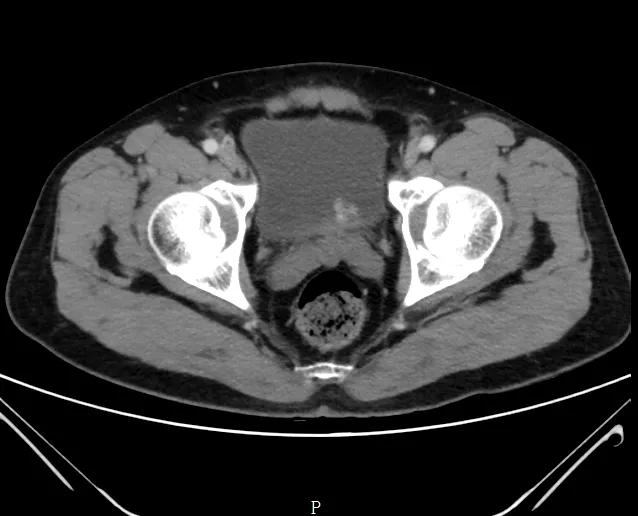 中年人血尿癌症几率是多少,老年人血尿是膀胱肿瘤吗
