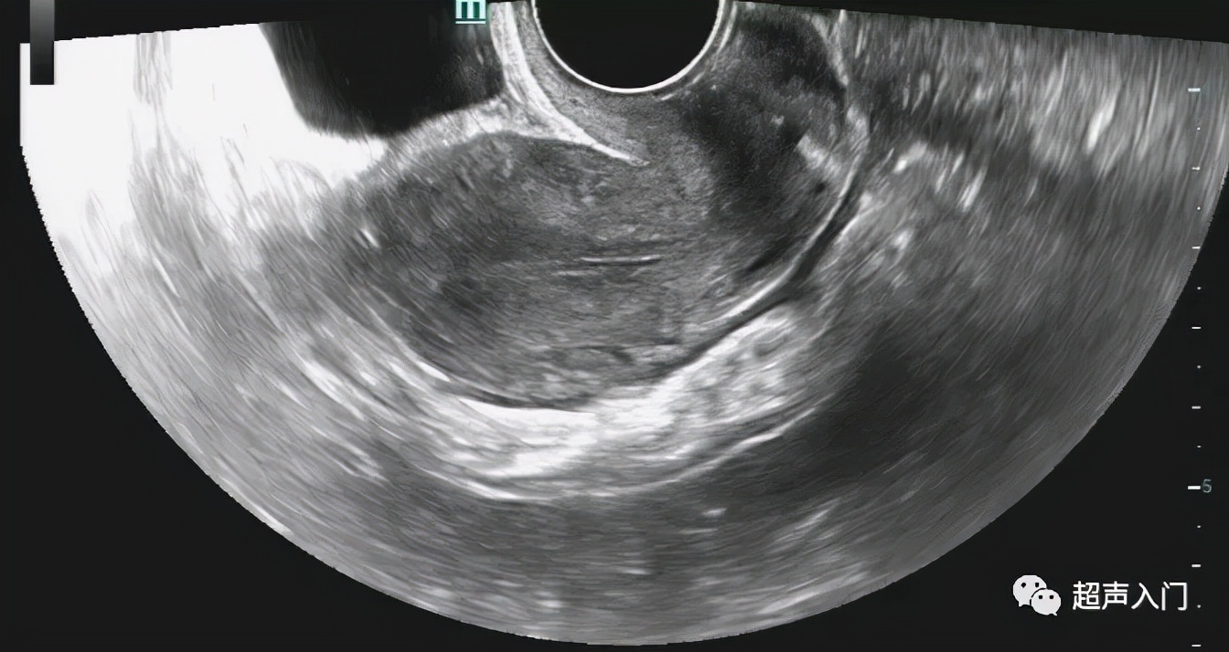 超声如何判断子宫位置,超声上怎么判断子宫后位