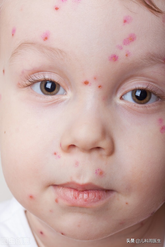 春天起水痘,如何辨别水痘和麻疹