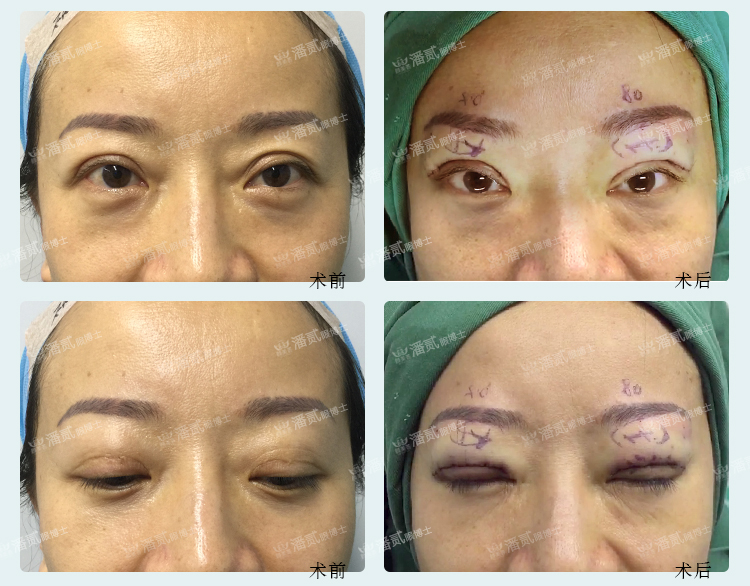 双眼皮失败的女孩,双眼皮失败做成了三眼皮好修复吗