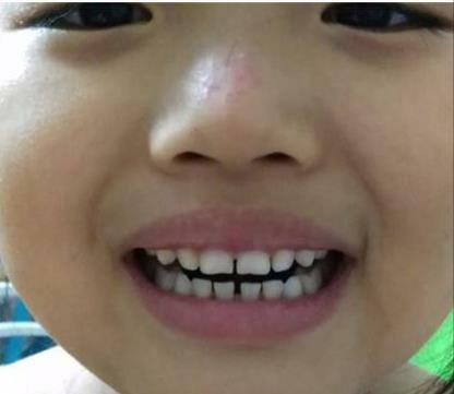 孩子牙缝大什么时候矫正,五岁孩子的牙怎么牙缝越来越大了