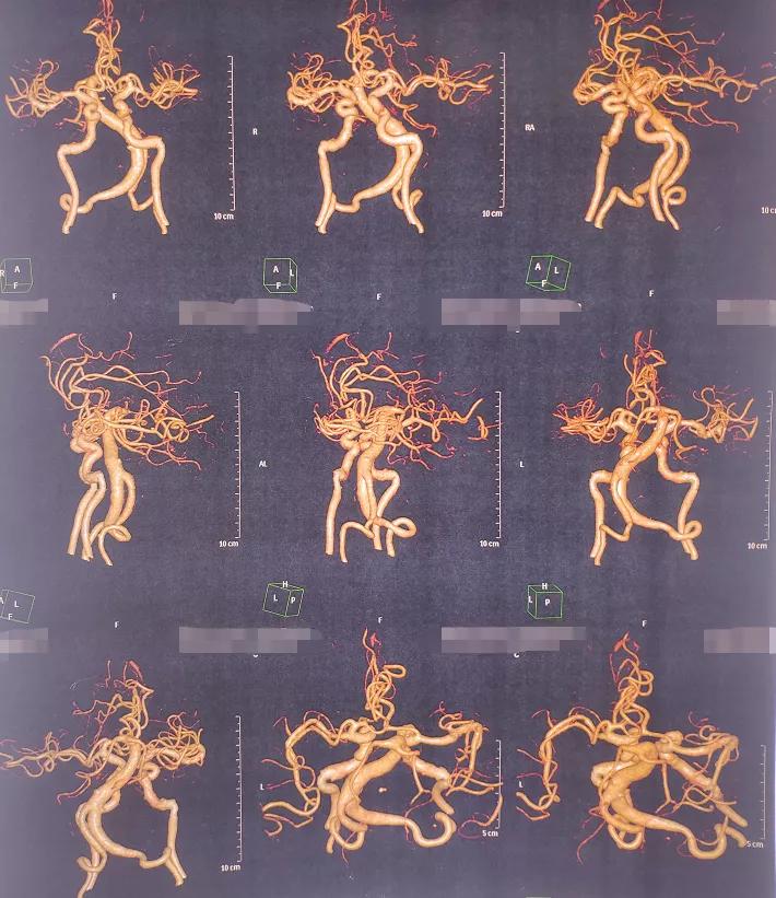 面肌痉挛球囊压迫和微血管减压术,微血管减压术治疗三叉神经痛