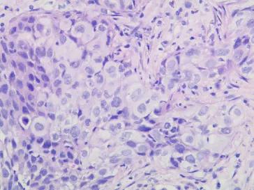 肺癌晚期可以靶向加免疫治疗吗,肺癌晚期化疗加免疫治疗有效吗