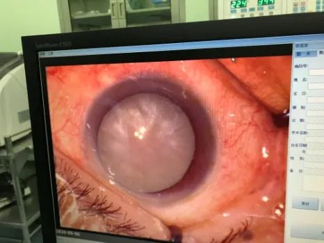 胶南高度近视白内障手术,烟台毓璜顶眼科白内障哪个大夫好