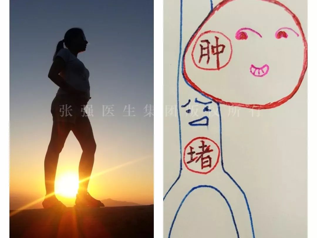 「鼠年“鼠你好孕”」做到这3点，让你轻松应对孕期下肢静脉曲张