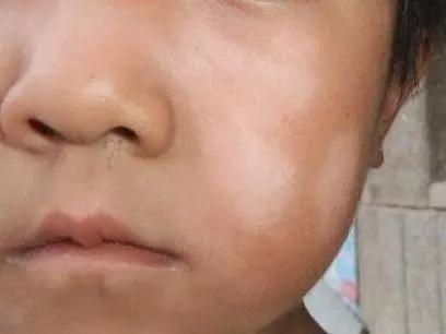 1岁宝宝有寄生虫的表现,关于宝宝感染寄生虫