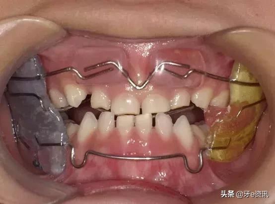 狗狗乳牙地包天怎么办,儿童乳牙地包天怎么办