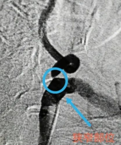 老人头痛怎么治疗最有效,通则不痛的最佳方法