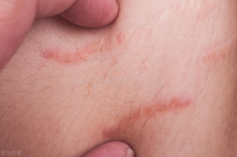 什么是疤痕体质呢,什么是疤痕体质有遗传因素吗