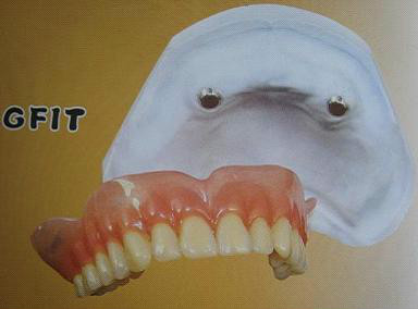 假牙的种类及价格详细介绍图片,目前国内最好的假牙是多少钱